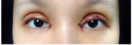 全切雙眼皮+去皮去脂+開眼角一個(gè)月了~