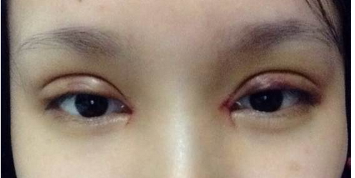 全切雙眼皮+去皮去脂+開眼角一個(gè)月了~