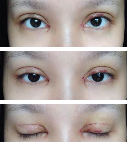 全切雙眼皮+去皮去脂+開眼角一個(gè)月了~