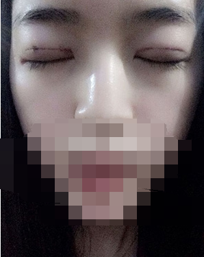 做埋線雙眼皮一周啦~果滿滿的！