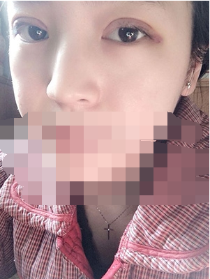 做埋線雙眼皮一周啦~果滿滿的！