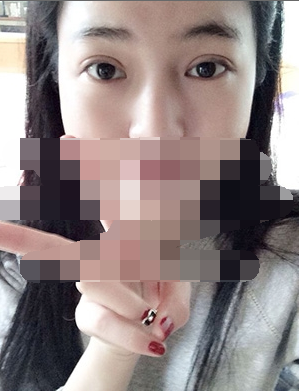 做埋線雙眼皮一周啦~果滿滿的！