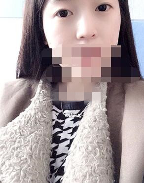 做埋線雙眼皮一周啦~果滿滿的！