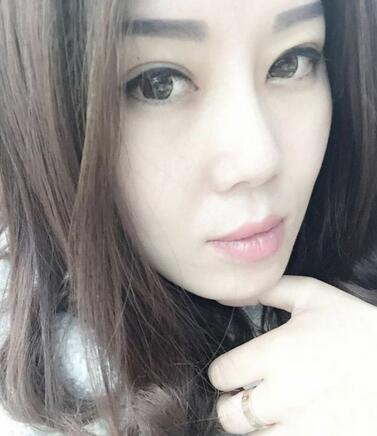 雙眼皮恢復(fù)記錄 果很滿意~