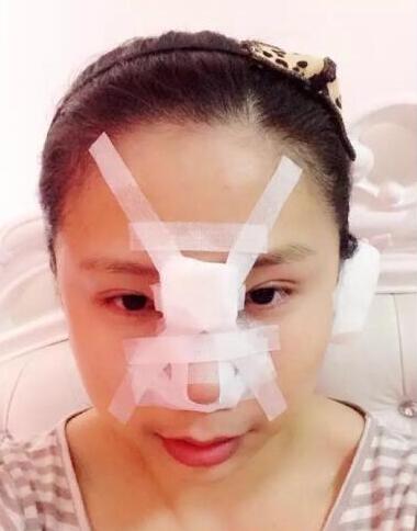 項昌峰醫(yī)生做的隆鼻整形速來看看果怎么樣