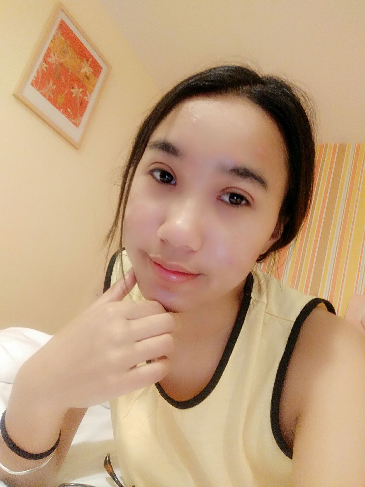 8.15號割的雙眼皮 感謝慕醫(yī)生