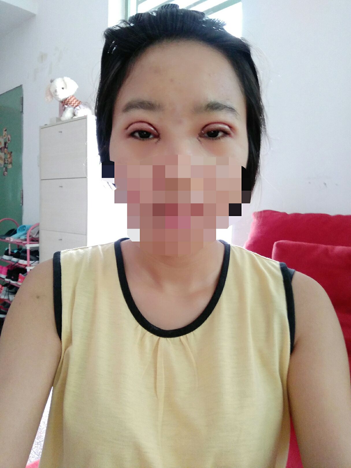 8.15號割的雙眼皮 感謝慕醫(yī)生