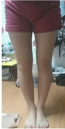 大腿吸脂三個(gè)月 瘦了很多