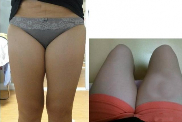 大腿吸脂三個(gè)月 瘦了很多