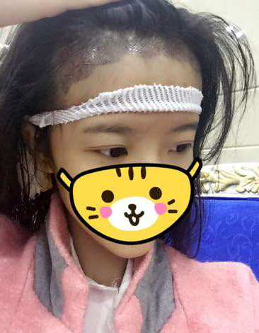 成都玉之光發(fā)際線種植 果不錯(cuò)~