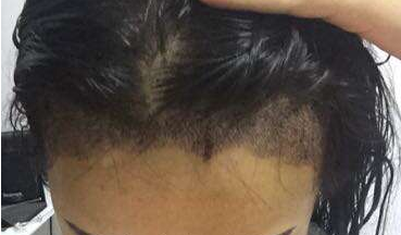 成都玉之光發(fā)際線種植 果不錯(cuò)~