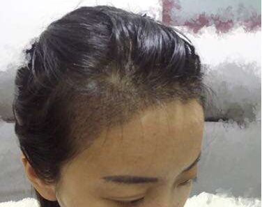 成都玉之光發(fā)際線種植 果不錯(cuò)~