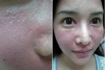 成都玉之光激光嫩膚經(jīng)歷 愛美的MM一定要看