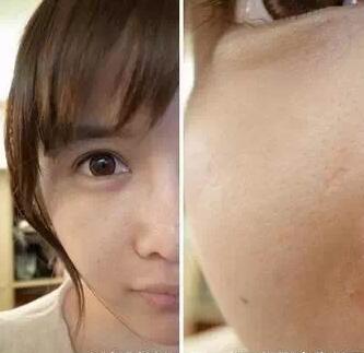 成都玉之光激光嫩膚經(jīng)歷 愛美的MM一定要看