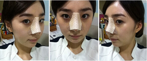 深圳希思崔院長隆鼻整形 擺脫了豬妹妹的稱號