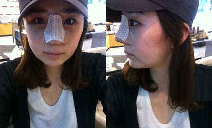 深圳希思崔院長隆鼻整形 擺脫了豬妹妹的稱號