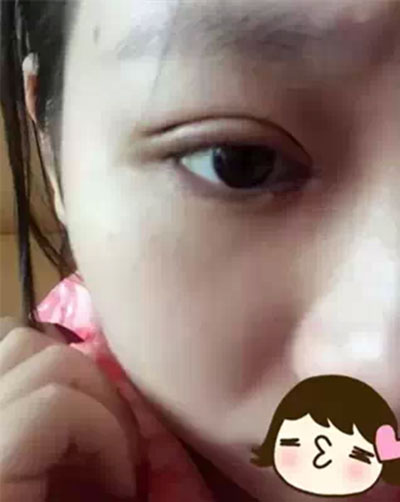 深圳希思做的雙眼皮+開眼角 感謝楊醫(yī)師!