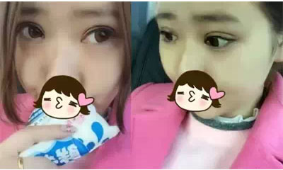 深圳希思做的雙眼皮+開眼角 感謝楊醫(yī)師!