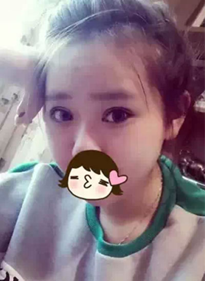 深圳希思做的雙眼皮+開眼角 感謝楊醫(yī)師!