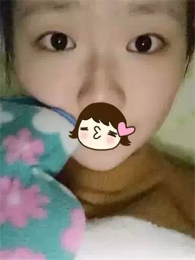 深圳希思做的雙眼皮+開眼角 感謝楊醫(yī)師!