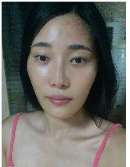 柳大烈給我做的改臉型手術(shù) 求圍觀！