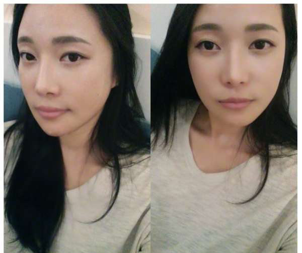 柳大烈給我做的改臉型手術(shù) 求圍觀！