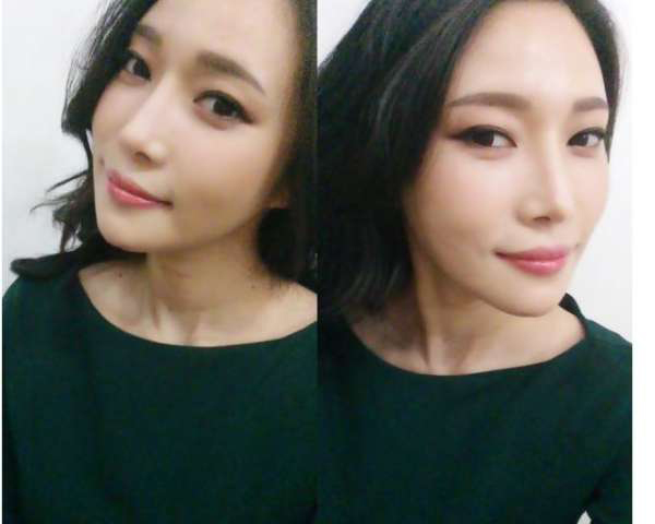 柳大烈給我做的改臉型手術(shù) 求圍觀！