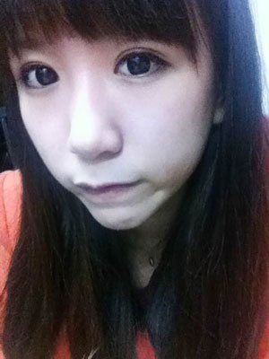 北北京常好麗格三點(diǎn)定位雙眼皮恢復(fù)一個(gè)月經(jīng)歷