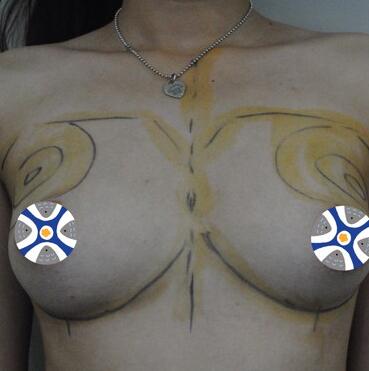 艾米麗自體脂肪隆胸恢復(fù)經(jīng)歷