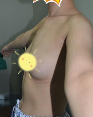 自體脂肪豐胸對(duì)比圖 抽脂隆胸十天