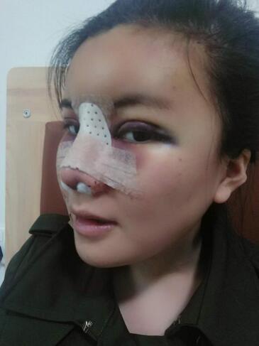 假體隆鼻兩個(gè)月后的感覺 隆鼻整形手術(shù)恢復(fù)日記