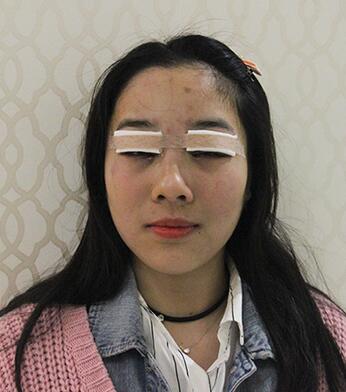 開眼角加雙眼皮15天恢復(fù)圖