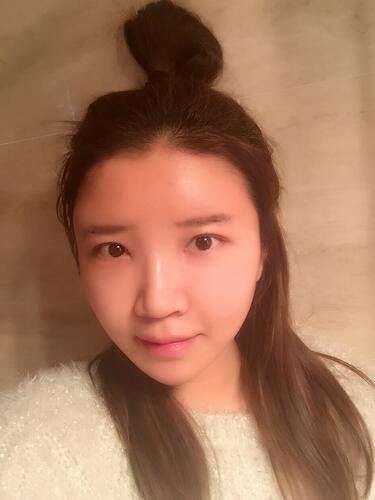 自體脂肪填充全臉1個月經(jīng)歷