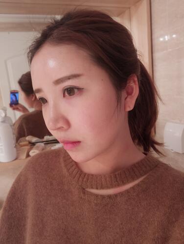 自體脂肪填充全臉1個月經(jīng)歷