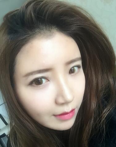 自體脂肪填充全臉1個月經(jīng)歷