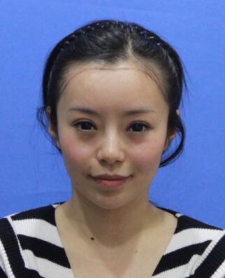 發(fā)際線調(diào)整案例分享 北京熙朵發(fā)際線+眉毛種植