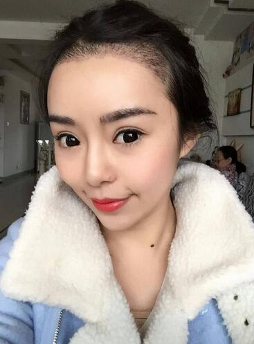 發(fā)際線調(diào)整案例分享 北京熙朵發(fā)際線+眉毛種植