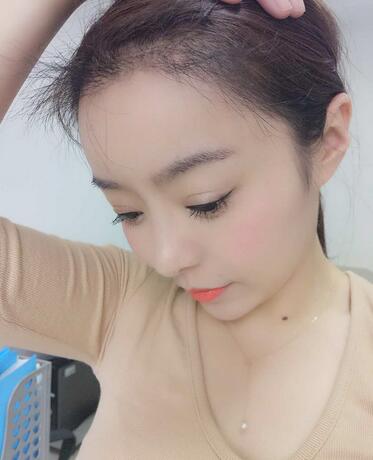 發(fā)際線調(diào)整案例分享 北京熙朵發(fā)際線+眉毛種植