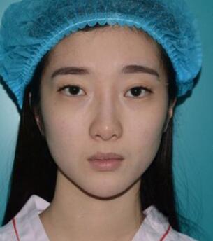 雙眼皮修復(fù)+自體脂肪填充恢復(fù)日記