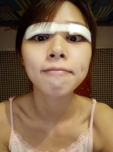 北京熙朵全切雙眼皮1個(gè)月恢復(fù)日記