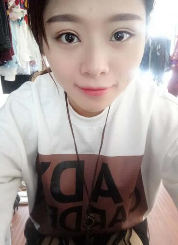 北京熙朵全切雙眼皮1個(gè)月恢復(fù)日記