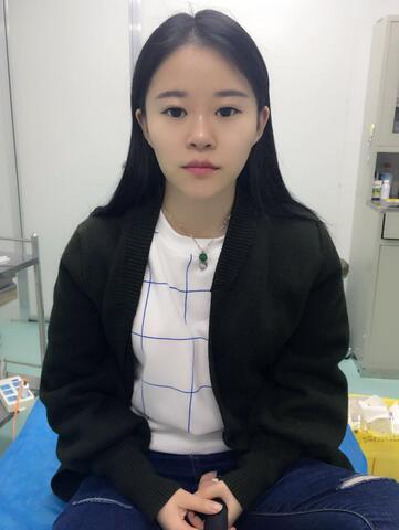 玻尿酸隆鼻恢復(fù)過程圖