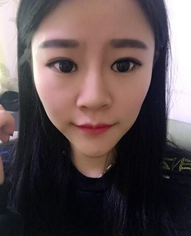 玻尿酸隆鼻恢復(fù)過程圖