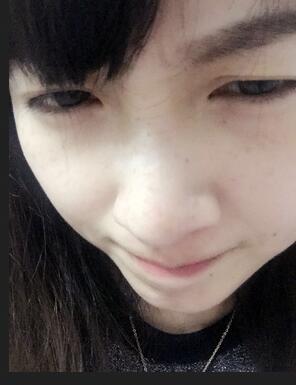 去魚尾紋的很好方法 注射瘦臉去魚尾紋果分享