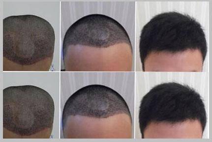 杭州植發(fā)大約多少錢、植發(fā)果圖
