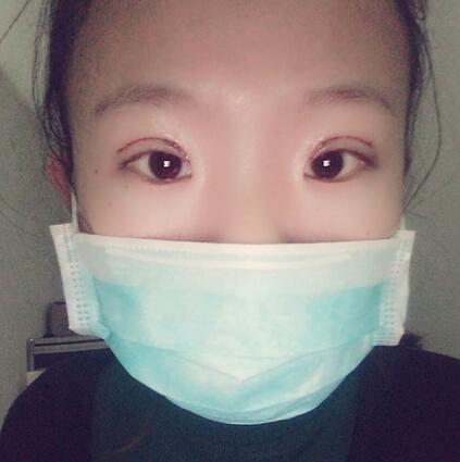 割雙眼皮術(shù)后恢復(fù)過程 全切雙眼皮3個月