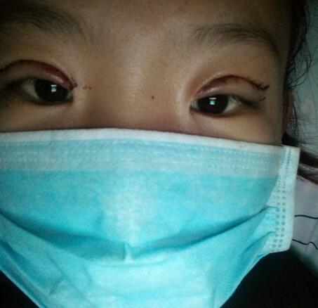 割雙眼皮術(shù)后恢復(fù)過程 全切雙眼皮3個月