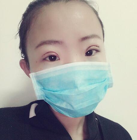 割雙眼皮術(shù)后恢復(fù)過程 全切雙眼皮3個月