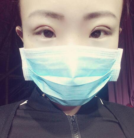 割雙眼皮術(shù)后恢復(fù)過程 全切雙眼皮3個月