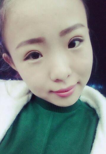 割雙眼皮術(shù)后恢復(fù)過程 全切雙眼皮3個月